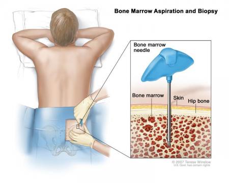 Biopsy for Lymphoma