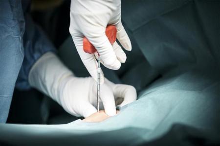 Biopsy for Lymphoma