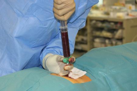 Biopsy for Lymphoma