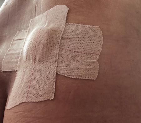Biopsy for Lymphoma