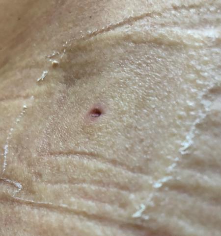 Biopsy for Lymphoma