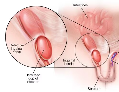 Inguinal hernia