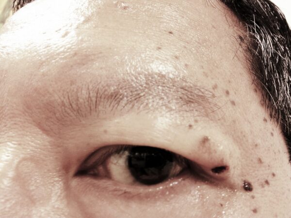 2012 Skin Tag