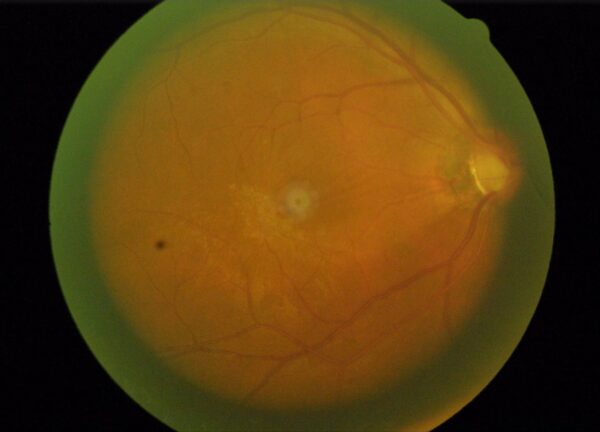 2018 Retina Scan