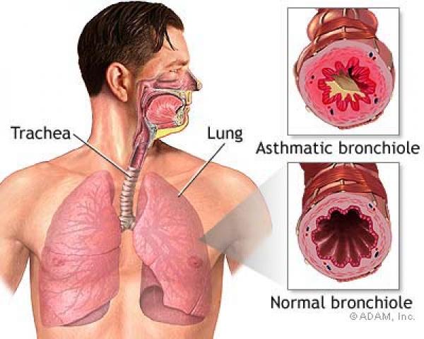 Asthma Diagram