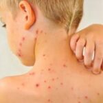 Chickenpox