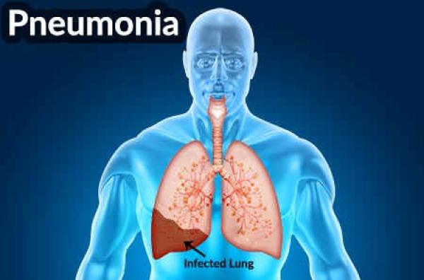 Pneumonia