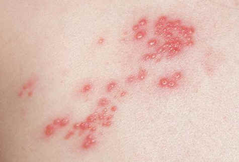 Shingles