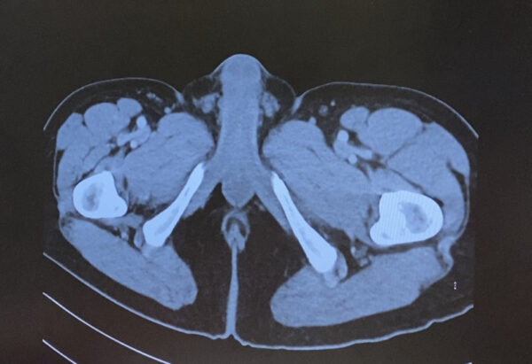 My full body CT Scan in nude